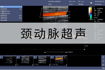 頸動(dòng)脈多普勒彩超